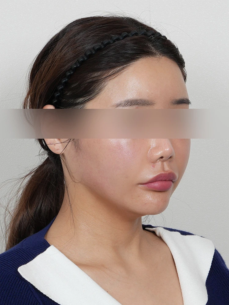 Case 1 After