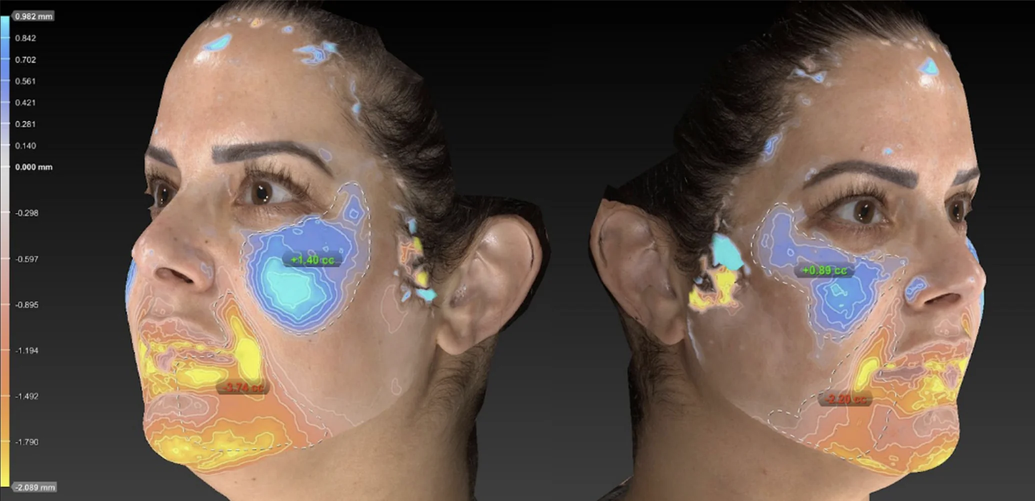 엠페이스의 중안부 볼륨 회복 효과