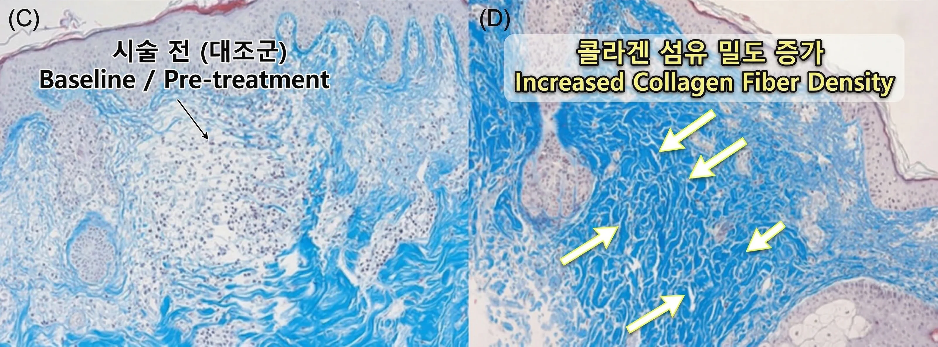 실제 쥬베룩 시술 후 진피 내 조직학적 변화