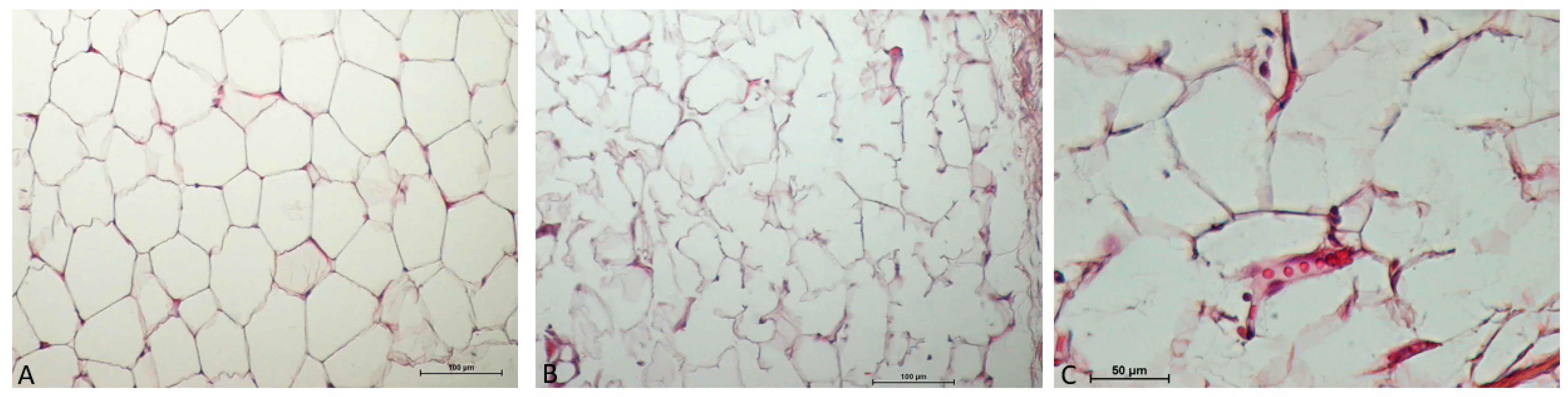 온다리프팅 시술 후 지방층의 조직학적 변화 현미경 사진