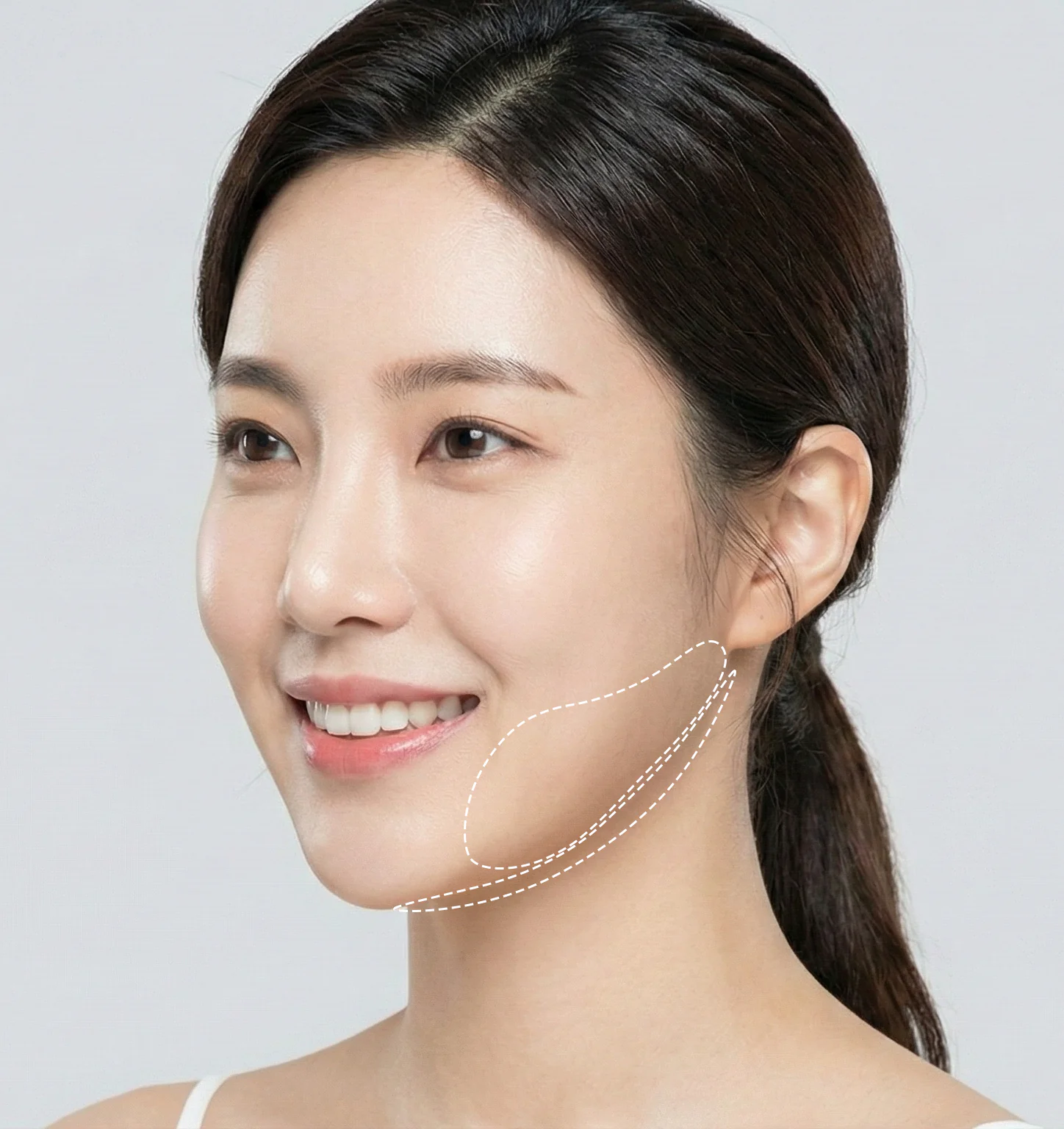 온다리프팅 시술 가능한 부위