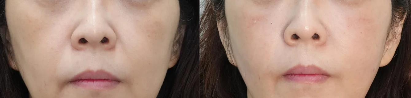 중안부·앞볼 포인트 리프팅 효과