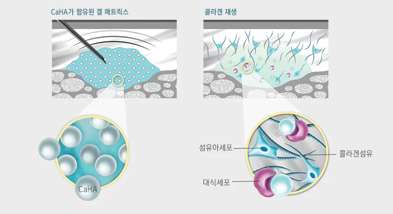 레디어스 시술 후 콜라겐 재생으로 인한 피부 속 변화