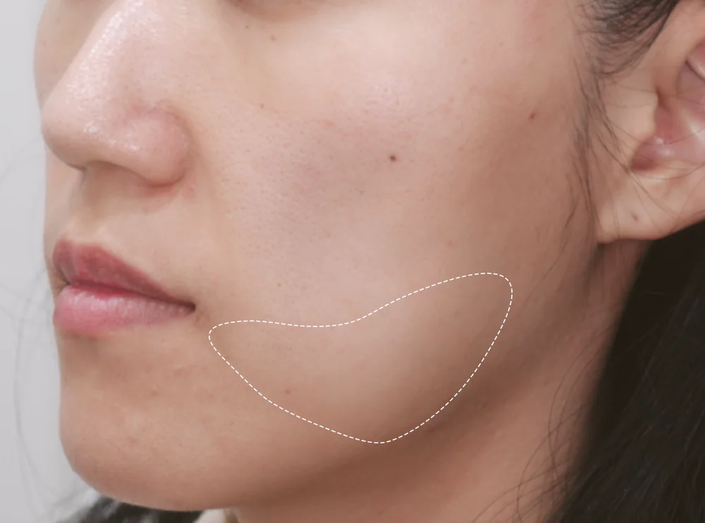 얼굴 살이 없는 사람의 볼처짐