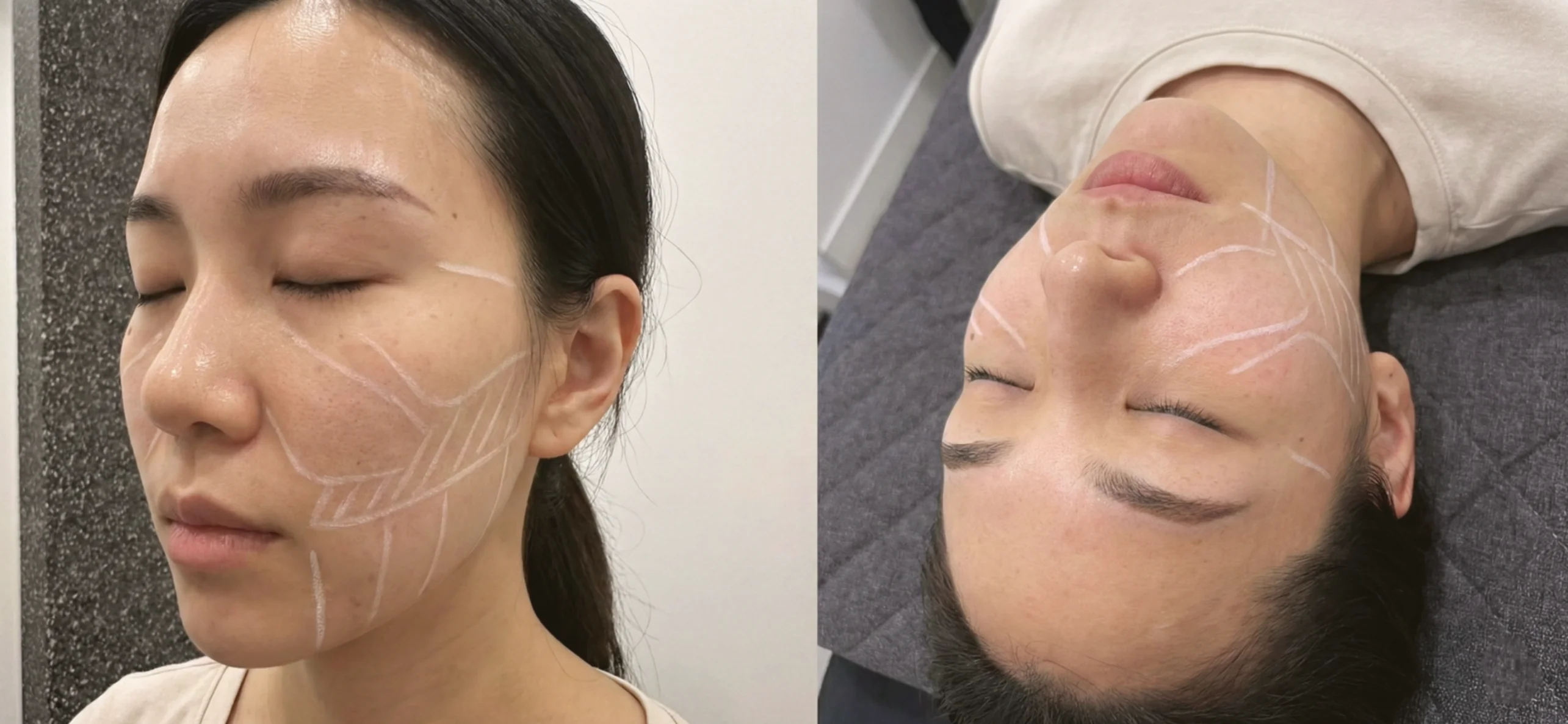 울쎄라 시술 전 볼패임을 예방하기 위한 디자인