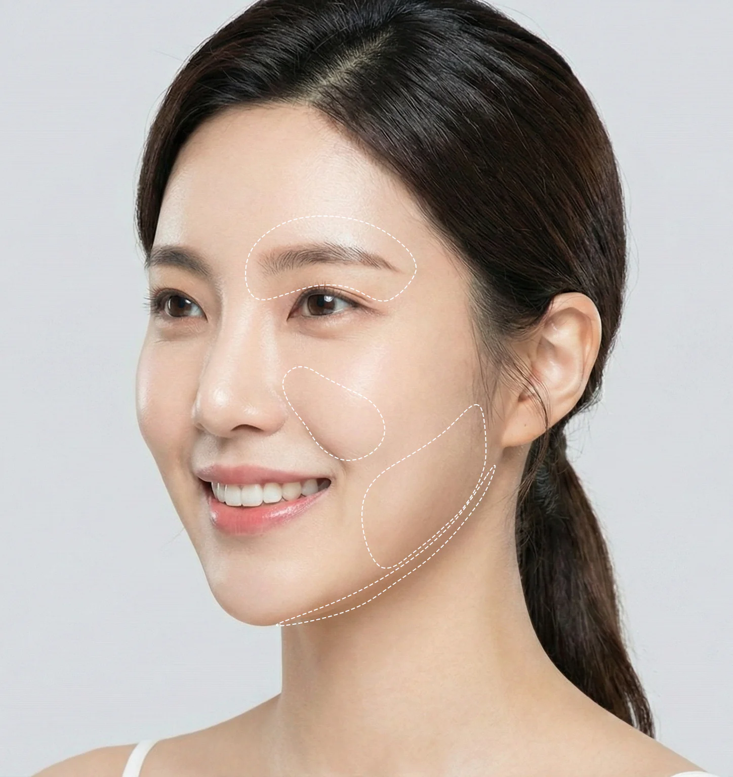 울쎄라 시술 가능 부위 - 눈썹, 팔자주름, 볼처짐, 이중턱