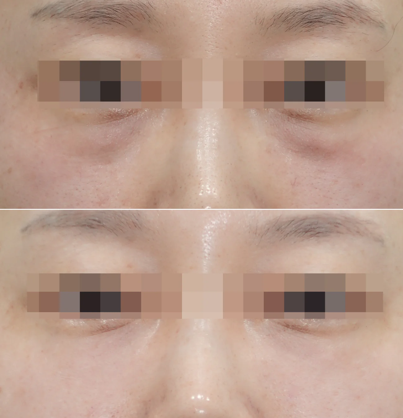 레스틸렌 아이라이트 시술의 눈밑 지방 마스킹 효과