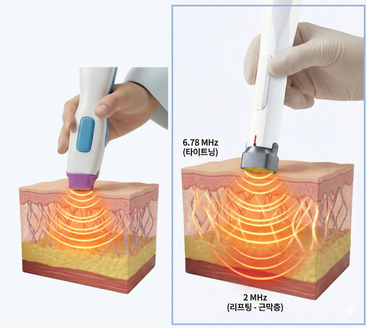써마지와 세르프의 에너지 도달 깊이 차이 비교