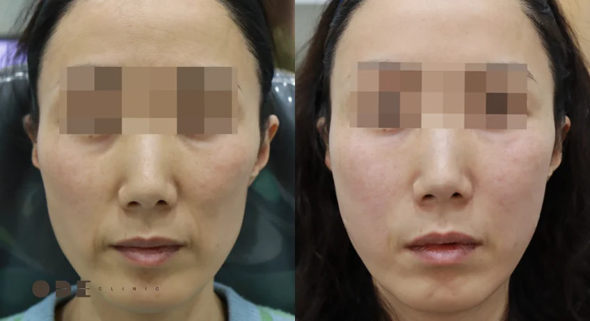 땅콩형얼굴, 볼패임, 볼꺼짐 시술 가이드 (필러, 쥬베룩볼륨, 리프팅 등)