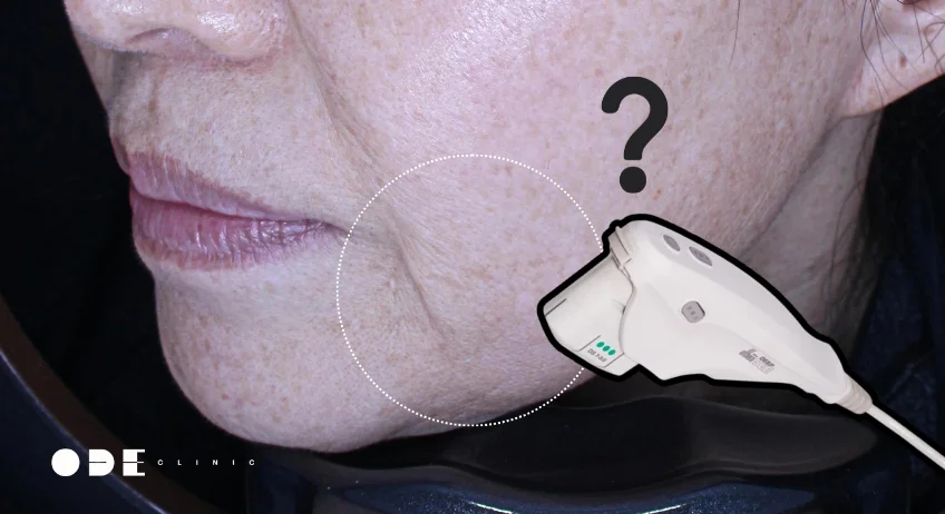 美國音波（Ulthera）對嘴邊肉效果有限？專業醫師解析木偶紋改善的全方位復合式策略