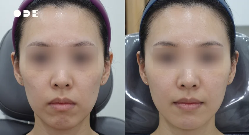 Juvelook Volume 維持多久？江南名醫解析效果與長效持久的秘訣 | ODE clinic