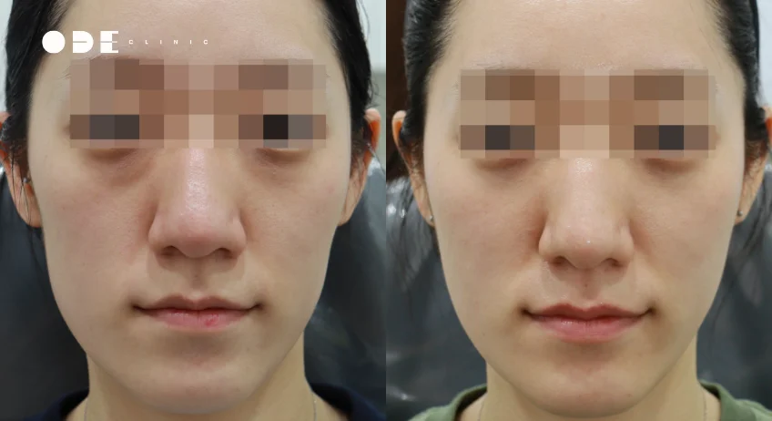얼굴 좌우 비대칭 볼 필러 교정 사례｜20대 여성 케이스 리뷰